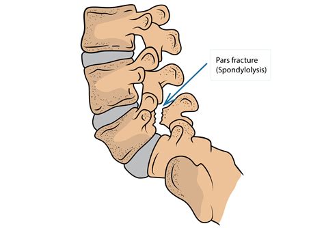 Pars Fracture Lumbar Spine