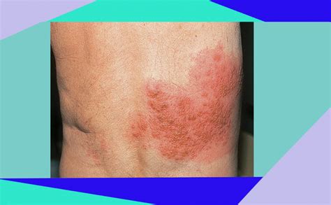 herpes rs ypk mandiri