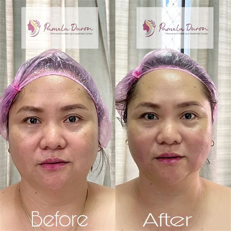 Best combination for melting fats with face and body contouring. DM us