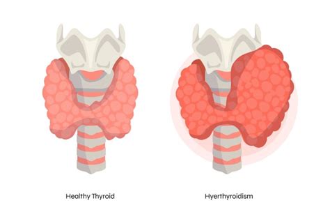 normal thyroid gland