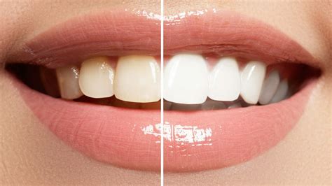 Benefits of Professional Teeth Whitening