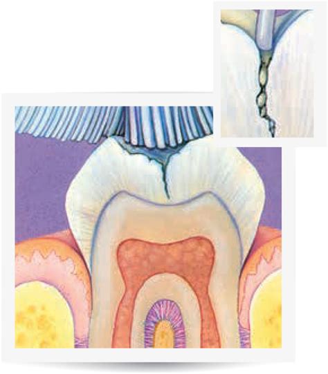 Pit and Fissure Sealants - Impressions Dental Centres