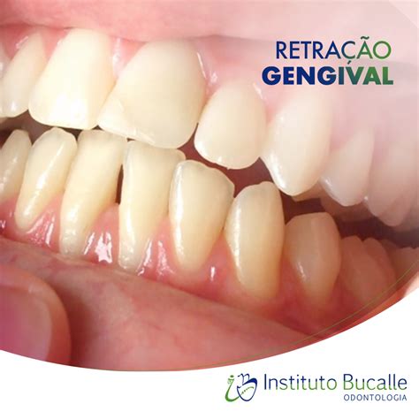 Retração Gengival Tem Cura - Retracao Gengival