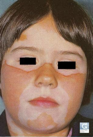 Витилиго (русский язык) | Globale Dermatologie