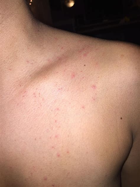 Body Wash For Malassezia Folliculitis at Rebecca Guay blog