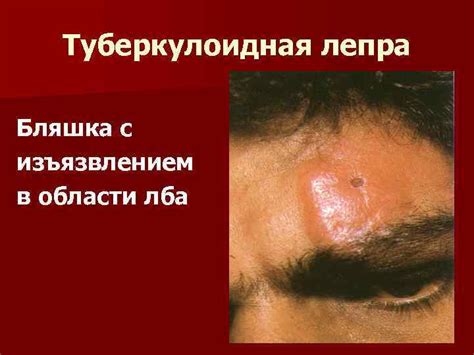 ЛЕПРА к. м. н. Демьянова О. Б.