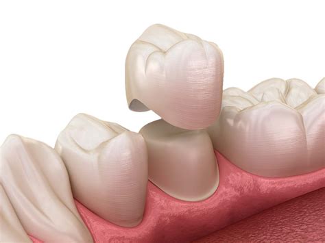 Coroa do dente: o que é? - Sorria Dentalprev