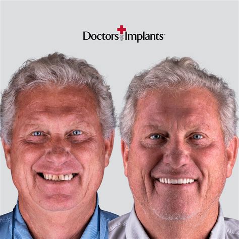 Sharing a real-life before and after... - Doctors Implants