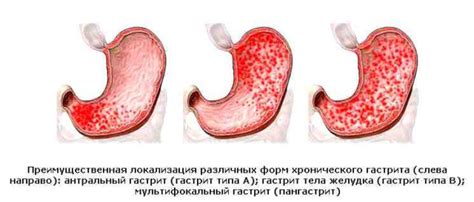 Анацидный гастрит: gastroscan — LiveJournal