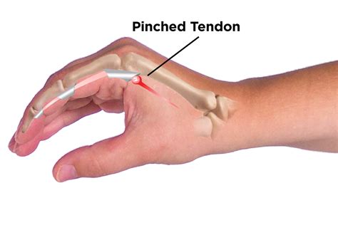 What Is Causing My Trigger Finger or Thumb To Lock?