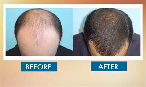 Before & After Hair Transplant - Sydney Hair Transplant Clinic