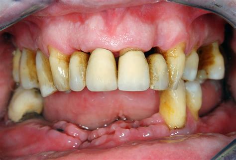 Periodontitis