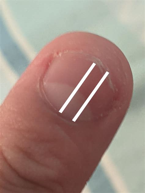 (3years ago i accidentally hit my fingernail in wood) is this a