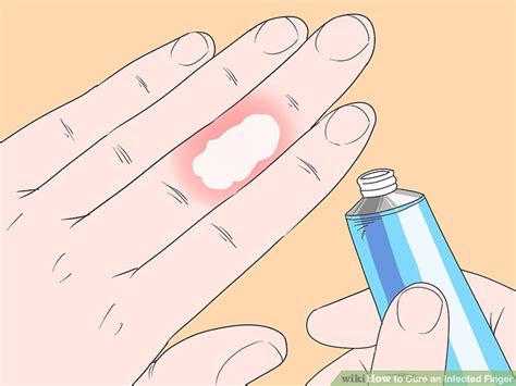 how to know if finger is infected