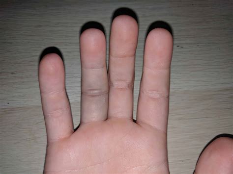 how to get a ring off a swollen finger 4