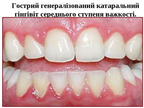 Етіологія, патогенез, клініка, діагностика, диференційна діагностика ...