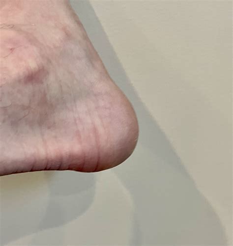 Cracked Heels Relief | Dry Feet | Powder Springs Podiatrist | Optimum