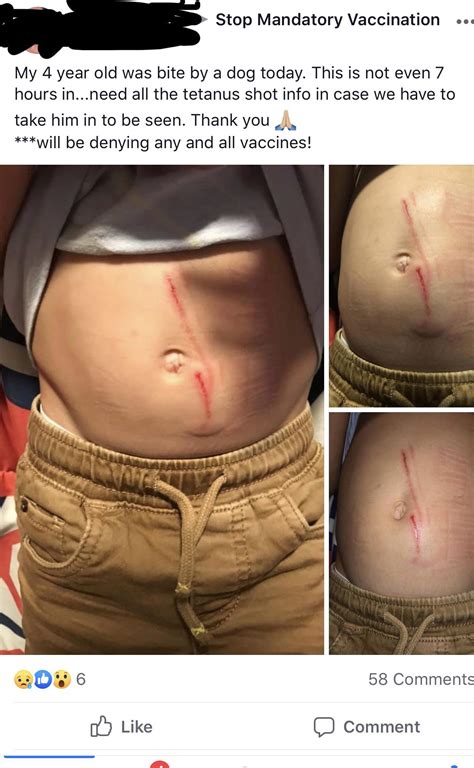 Should You Have A Tetanus Shot After A Dog Bite