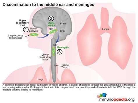 Streptococcal pneumoniae meningitis Case Study | Immunopaedia
