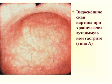 Хронический гастрит - презентация онлайн