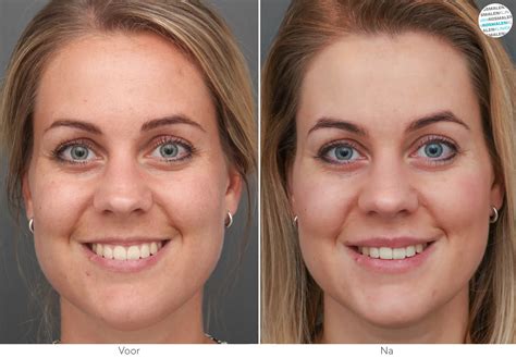 lip filling van rosmalen kliniek