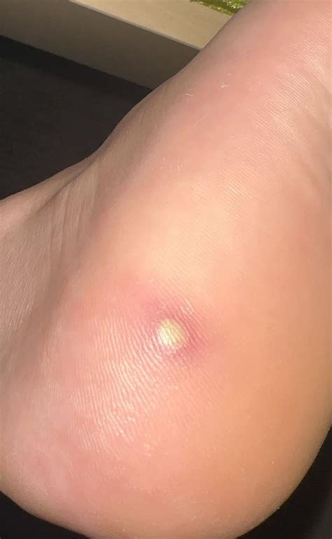 painful bump    buttcheek  isabella embry blog