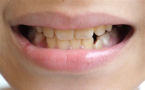 Why a Child's Teeth May Come in Yellow: Causes and Prevention Tips