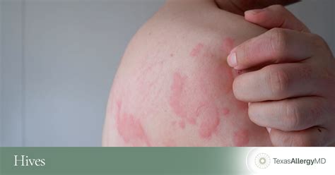 how to know if you have hives