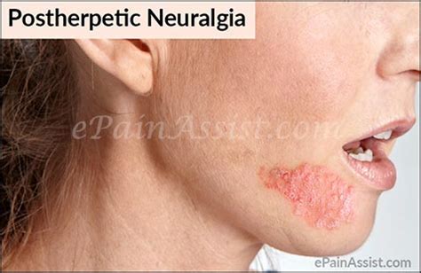 Postherpetic neuralgia