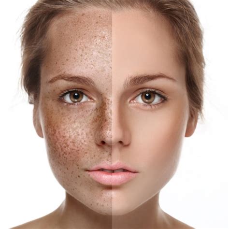 Sun Spot and Age Spot Removal - Dermatology Care of Charlotte