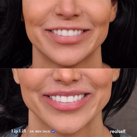 What Does Lip Implants Look Like at Lauren Murphy blog