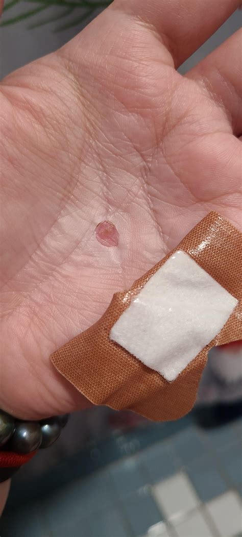 Does it look like it's gone? : r/Warts