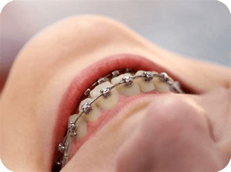 extractions dentist leamington spa