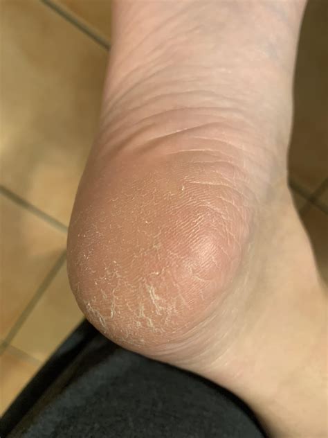 dry skin or athlete's foot / Moccassin-type tinea pedis? : r