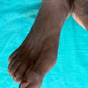 Non-pitting edema of left leg with thickening and cobble-stoning of ...