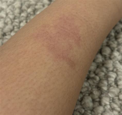 Lower Leg Skin Rashes? : r/skin