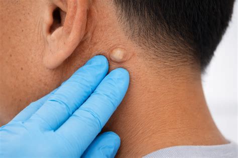 What Does a Cyst Look Like? Pictures of Different Types of Cysts