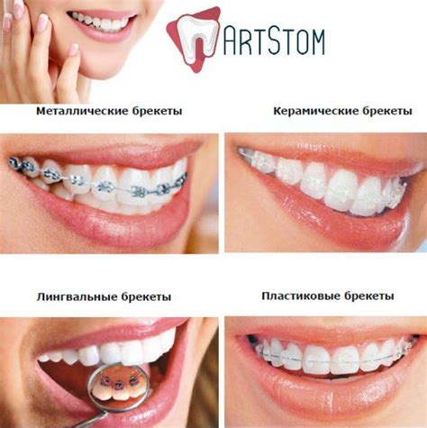 #Брекеты - это маленькие замочки. С помощью специального клея #ортодонт ...
