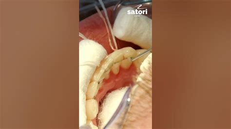 Фиксация ретейнера после снятие брекетов #брекеты #зубы #стоматология ...