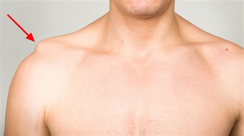 Separated Shoulder - Causes, Symptoms, Exercises, Treatment