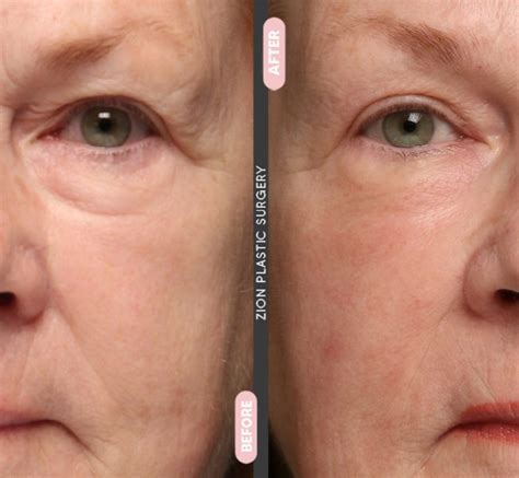 Discover definitive rejuvenation with Morfeus in Miami