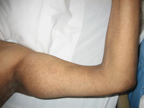Lateral antebrachial cutaneous nerve across the wound. Figure 2 Popeye ...