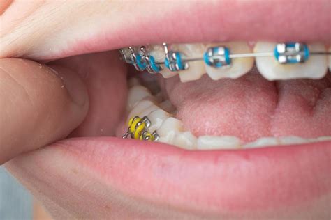 Braces with blue and yellow rubber bands close-up. 11771235 Stock Photo ...