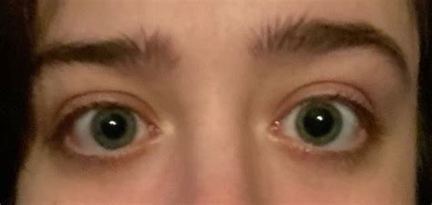 #anisocoria on Tumblr