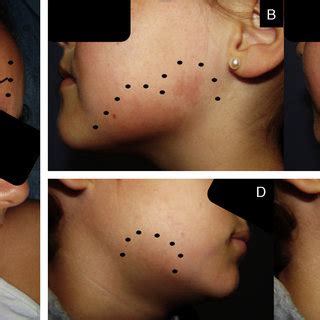 A, Patient 1. A reddish macule affecting the first and second branches ...