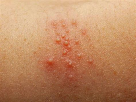Staph Infection: 10 Staph Infection Symptoms