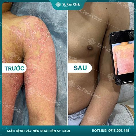 Phòng Khám Da Liễu St Paul | Hanoi
