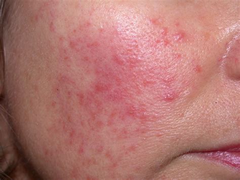 facial rashes whats  diagnosis