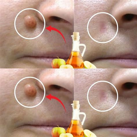 Apple Cider Vinegar: A Natural Solution for Removing Warts in 24 Hours