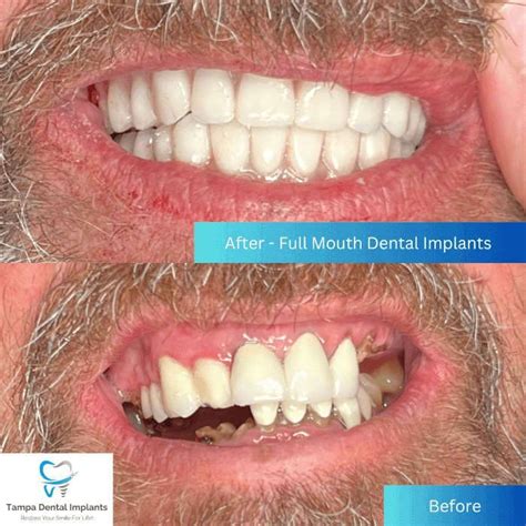 Tampa Dental Implants - Your Premier Local Dentist for Implants & More
